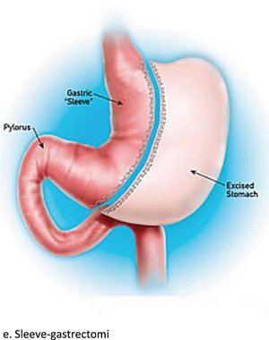 Beskrivning: Beskrivning: Macintosh HD:Users:par:Desktop:DN 1-2 2013 Till Frank:nr 9 Gastric Bypass:kirurgiska_fig1e.jpg